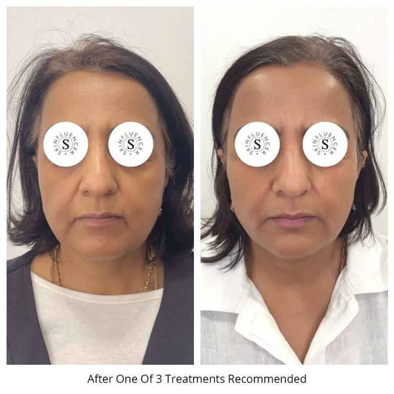 Non-Surgical Laser Facelift