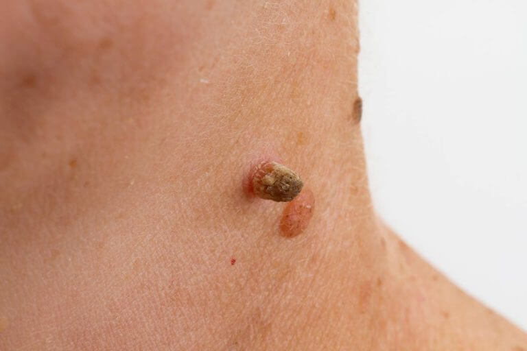 Benign-Lesions-Moles-Warts-Thread-Veins