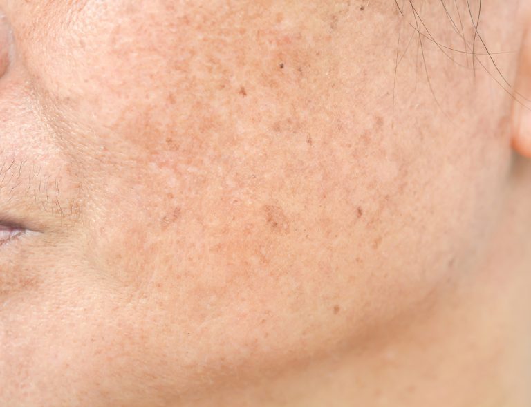 Manage-My-Melasma