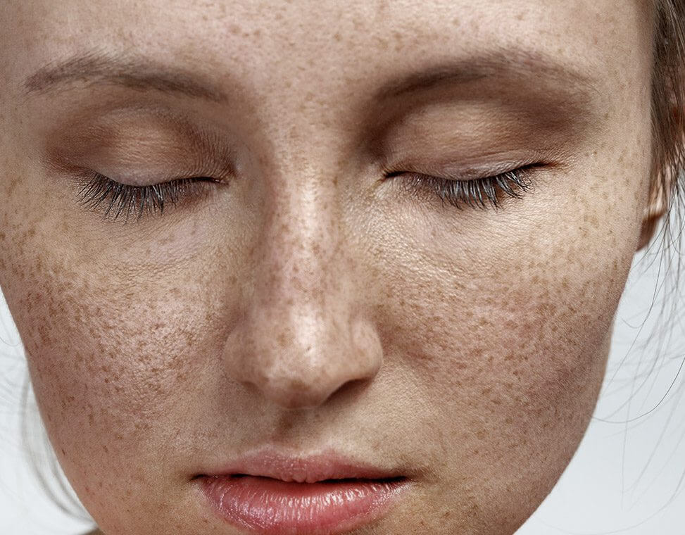 Shatter My Melasma Treatment