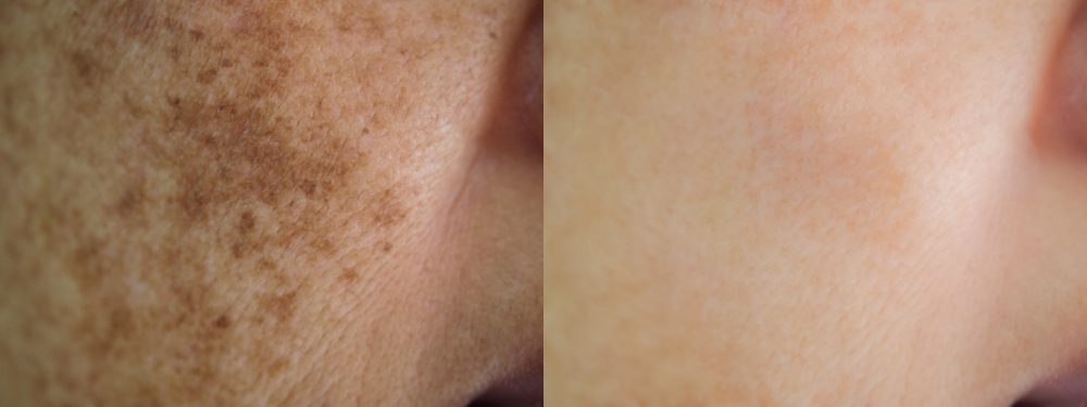 Sun-Damage-Removal-Treatment