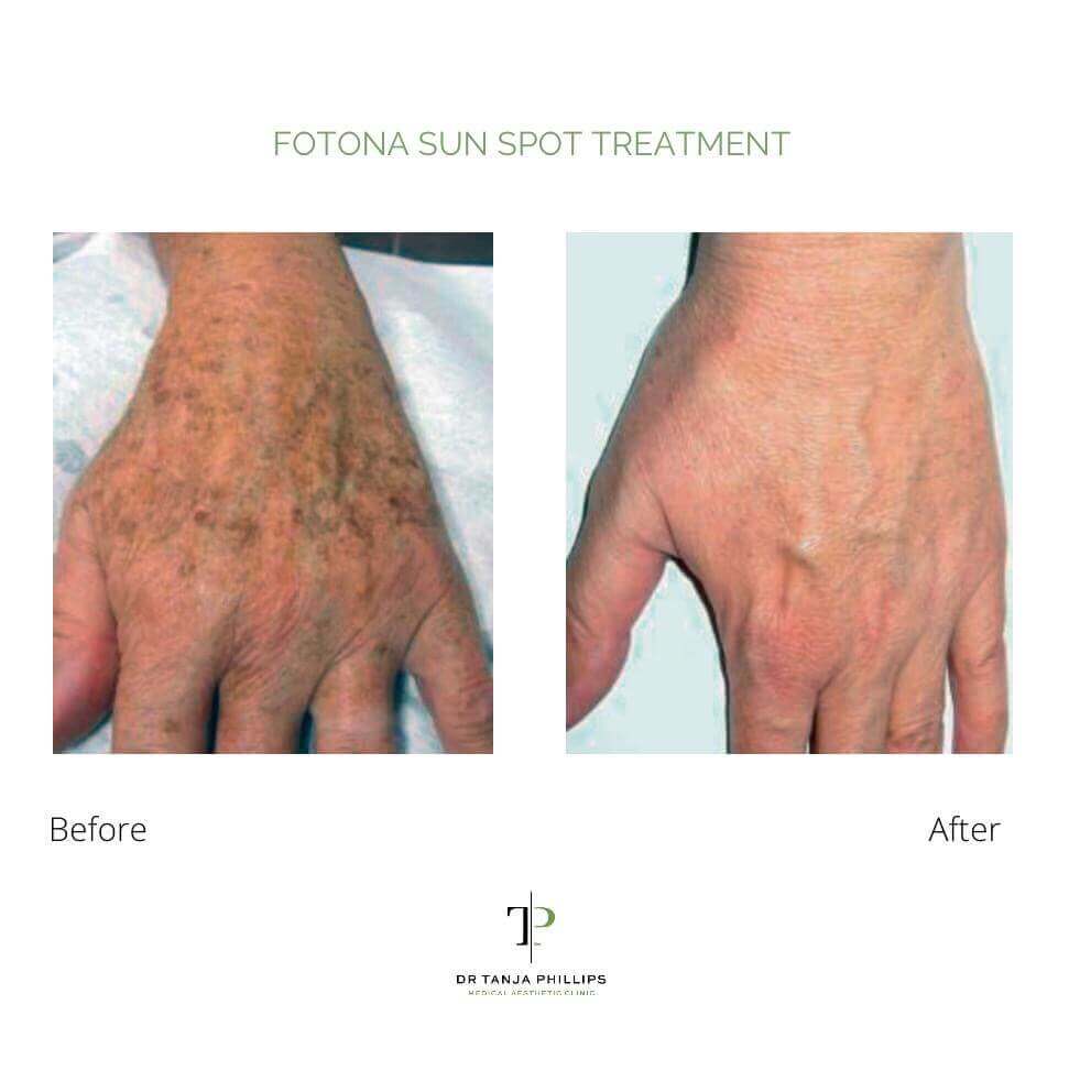 fotona-sun-spot-treatment fotona sun spot treatment