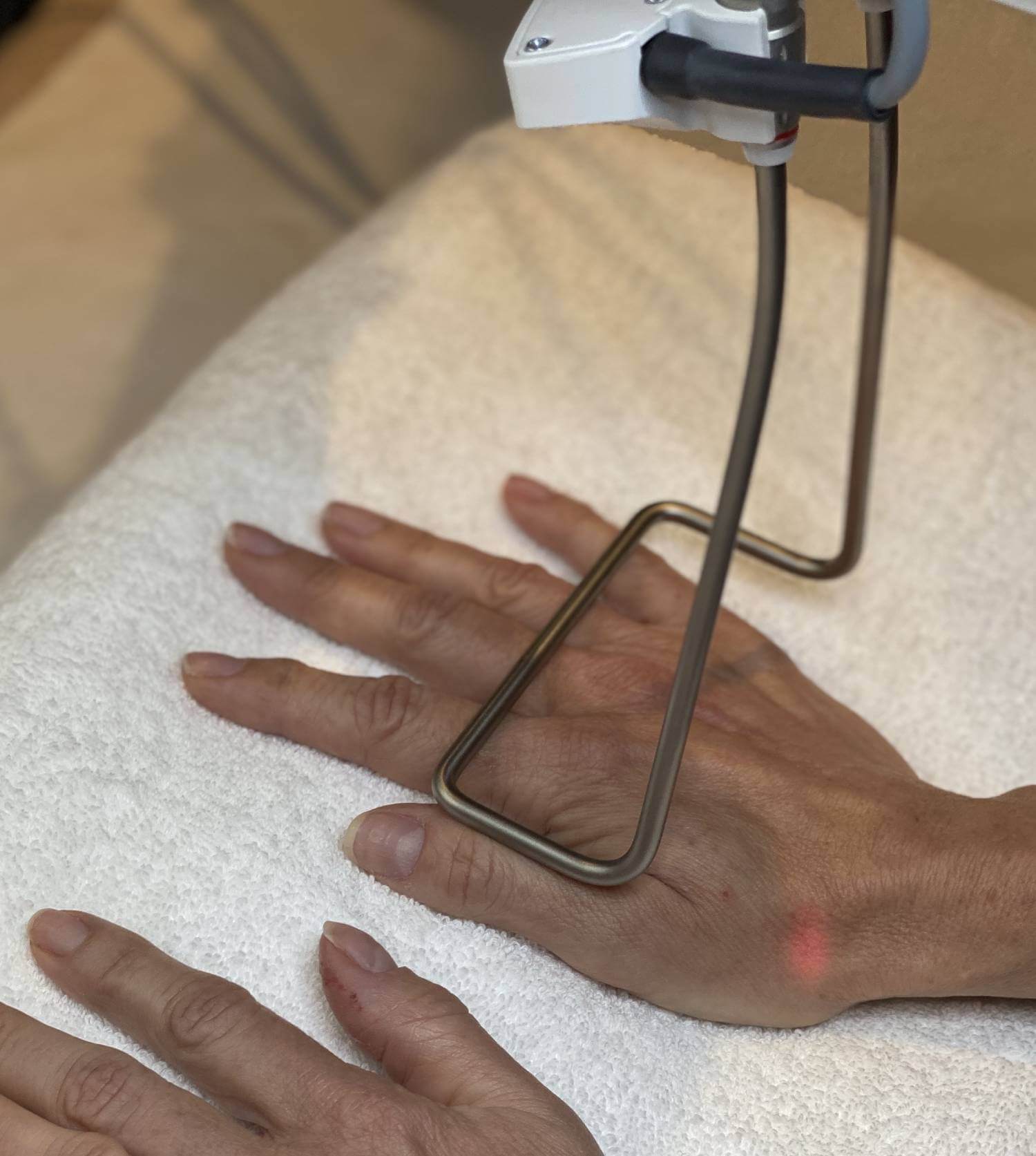 hand-rejuvenation-treatment