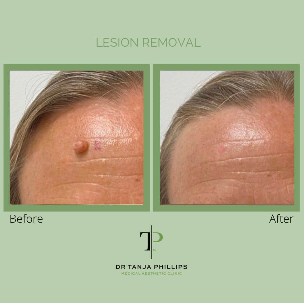 lesion-removal leson removal