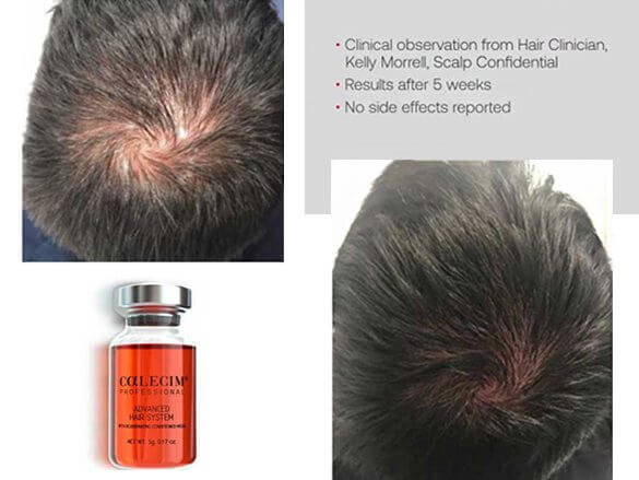 Hair-Restoration-Active-Growth-Factors