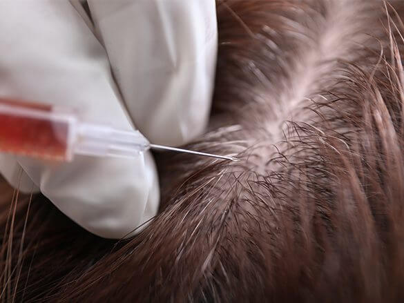 Hair-Restoration-your-bloods-own-rich-protiens